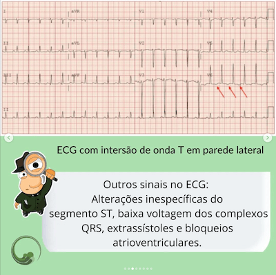 ECG Miocardite Wavesmed