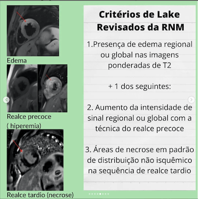 Critérios de Lake Ressonância cardíaca Miocardite Wavesmed