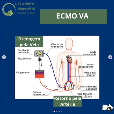 Tipo de ECMO Wavesmed<br />  ECMO veno arterial