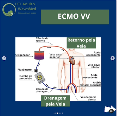 Tipo de ECMO Wavesmed<br />  ECMO Veno-venosa