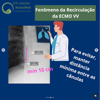 Tipo de ECMO Wavesmed<br />  Recirculação da ECMO veno-venosa (VV)