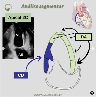 Função ventricular esquerda ecocardiograma<br />  Análise coronária correspondente<br />  Apical 2C