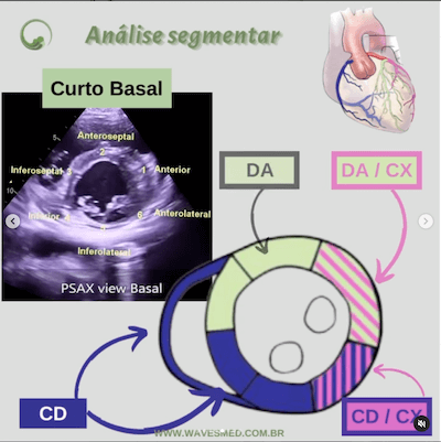 Função ventricular esquerda ecocardiograma Wavesmed<br />  Análise coronária correspondente<br />  Curto basal