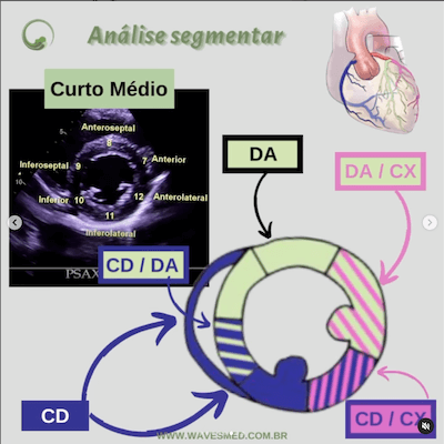 Função ventricular esquerda ecocardiograma Wavesmed<br />  Análise coronária correspondente<br />  Curto médio