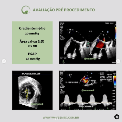 Avaliação pré procedimento<br />  Valvoplastia mitral por cateter balão Wavesmed