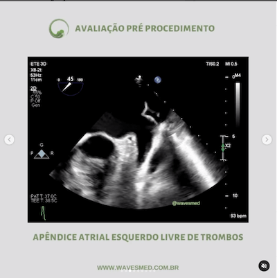 Pré procedimento<br />  Valvoplastia mitral por cateter balão Wavesmed