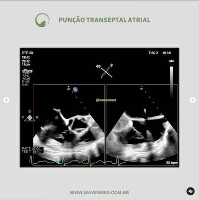 Punção transeptal atrial<br />  Valvoplastia mitral por cateter balão Wavesmed