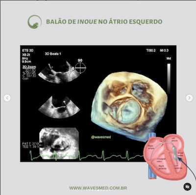 Balão de Inoue no átrio esquerdo<br />  Valvoplastia mitral por cateter balão Wavesmed