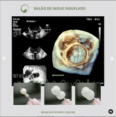 Balão Inoue insulflado<br />  Valvoplastia mitral por cateter balão Wavesmed