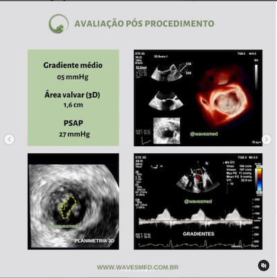 Pós procedimento<br />  Valvoplastia mitral por cateter balão Wavesmed