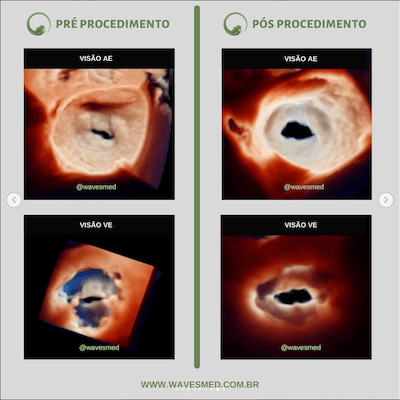 Pós valvoplastia<br />  Valvoplastia mitral por cateter balão Wavesmed