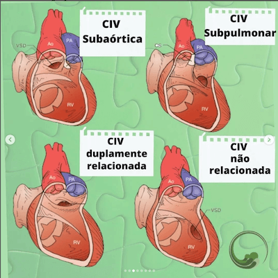 Anatomia Dupla via de saída do ventrículo direito Wavesmed