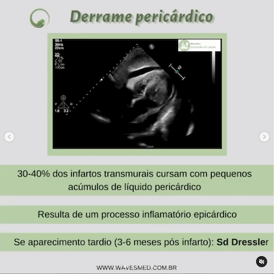 Complicações pós Infarto Agudo do Miocárdico Wavesmed<br />  Derrame pericárdico