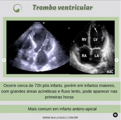 trombo ventricular<br />  Complicações pós Infarto Agudo do Miocárdico Wavesmed