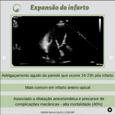 Expansao do Infarto<br />  Complicações pós Infarto Agudo do Miocárdico Wavesmed