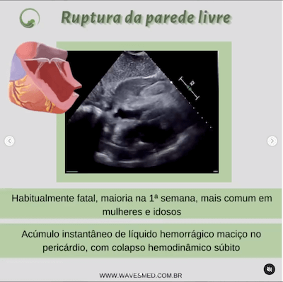 Ruptura de parede livre<br />  Complicações pós Infarto Agudo do Miocárdico Wavesmed