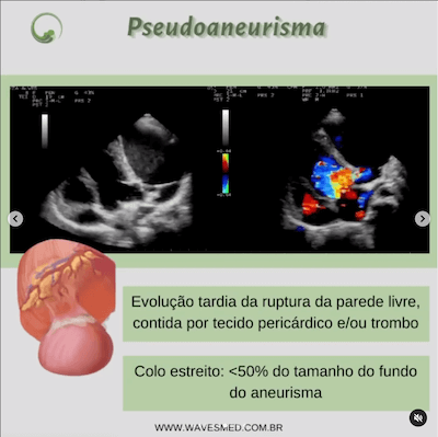 Pseudoaneurisma<br />  Complicações pós Infarto Agudo do Miocárdico Wavesmed