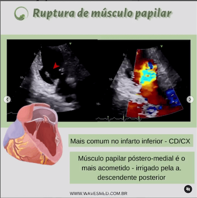 Ruptura de musculo papilar<br />  Complicações pós Infarto Agudo do Miocárdico Wavesmed