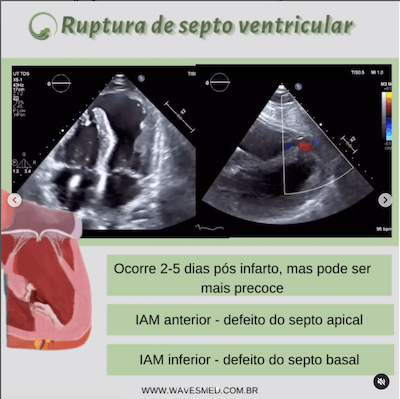 Ruptura do septo ventricular<br />  Complicações pós Infarto Agudo do Miocárdico Wavesmed