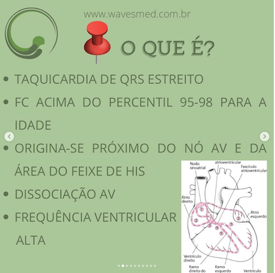 Definição JET Taquicardia Juncional Ectópica Wavesmed