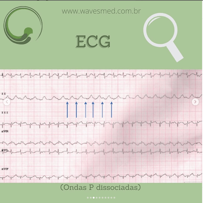 ECG JET Taquicardia Juncional Ectópica Wavesmed