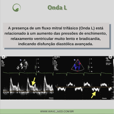 Onda L Função Diastólica onda L Wavesmed