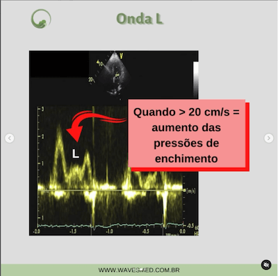 Ecocardiograma Função Diastólica onda L Wavesmed