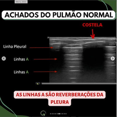 pulmoa-normal-ultrassom-UTI-wavesmed