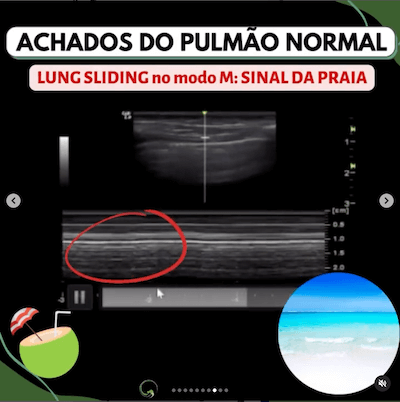 lung-sliding-sinal-praia-ultrassom-UTI-wavesmed