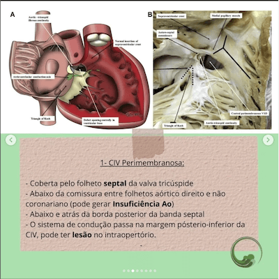 Perimembranosa classificacao comunicacao interventricular wavesmed