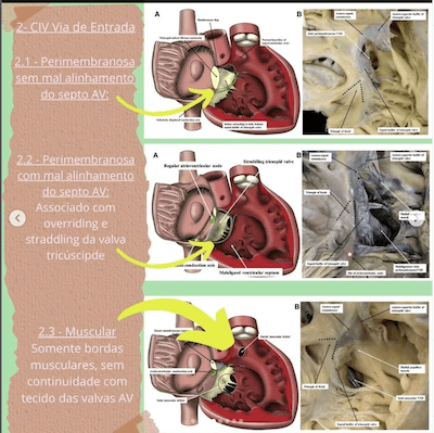 Via entrada classificacao comunicacao interventricular wavesmed