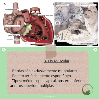 civ muscular classificacao comunicacao interventricular wavesmed