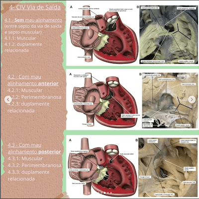 civ via saida classificacao comunicacao interventricular wavesmed