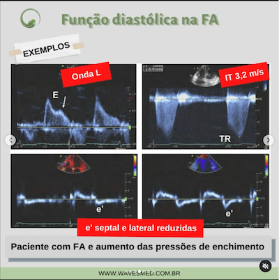 exemplos funcao diastolica fa wavesmed