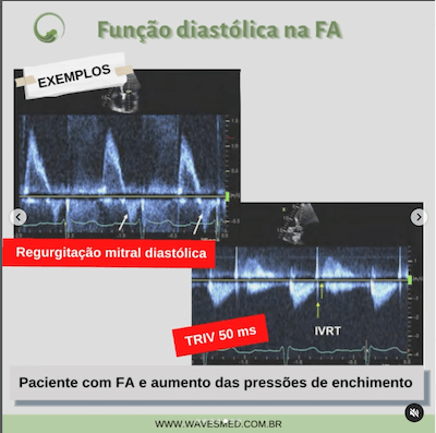 exemplos funcao diastolica fa wavesmed