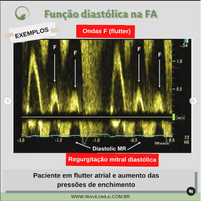 ondas f flutter funcao diastolica fa wavesmed