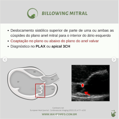 definicao billowing prolapso mitral wavesmed