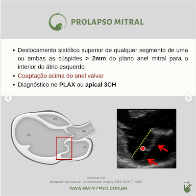 definicao prolapso billowing prolapso mitral wavesmed