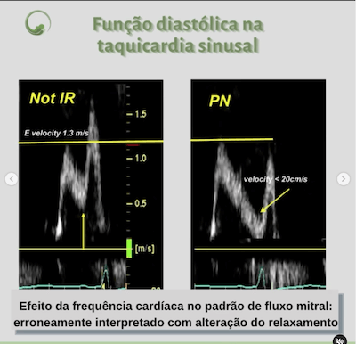 Taquicardia sinusal Função Diastólica BAV-marcapasso Wavesmed