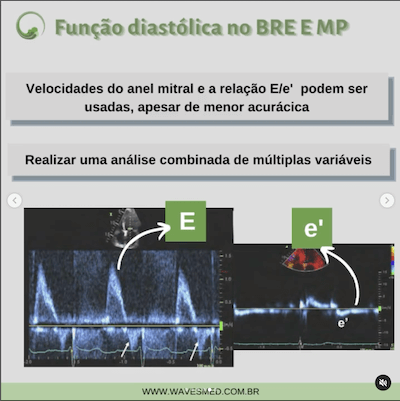 BRE marcapasso Função Diastólica BAV marcapasso wavesmed