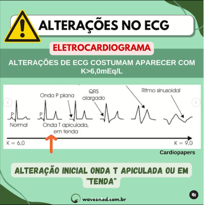 Alterações ecg hipercalemia uti pediátrica wavesmed