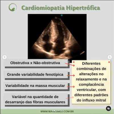 Classificação função diastólica cardiomiopatia hipertrófica wavesmed