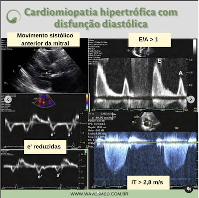 Movimento sistólico anterior mitral sem função diastólica cardiomiopatia hipertrófica wavesmed