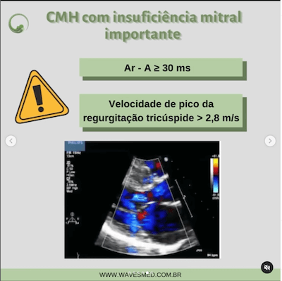 Insuficiência mitral importante função diastólica cardiomiopatia hipertrófica wavesmed